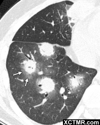  p>晕征是指某些疾病的肺ct 表现 晕征是一种磨玻璃影围绕结节或肿块