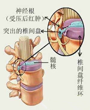 颈部纤维环前厚后薄,髓核易向后外侧脱出,突入椎管或椎间孔,压迫脊髓