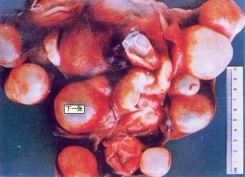 p>包虫病是棘球绦虫的幼虫寄生在人体所致的一种人兽共患寄生虫病.
