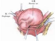 食管裂孔疝修补术