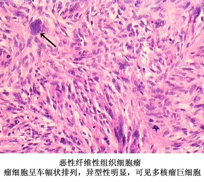 恶性纤维组织细胞瘤/a>是一种很少见的 a data-lemmaid"15525>肿瘤
