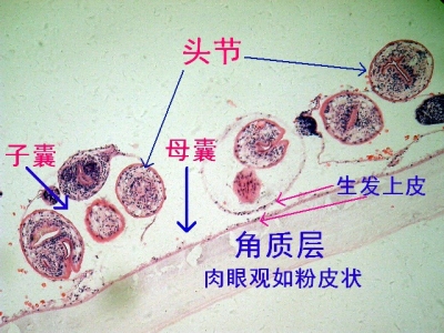  p></p></a>包虫病是棘球绦虫的幼虫寄生在人体所致的一种人兽共患寄生虫病.