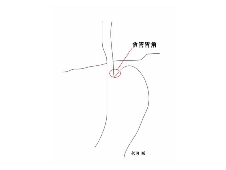 食管胃角
