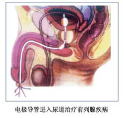 结合b超定位可视系统治疗 a href="#" data-lemmaid="4071534">前列腺