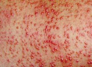  p></p></a>多发生于热带地区,以复发性红色粟粒疹患者多见. /p>