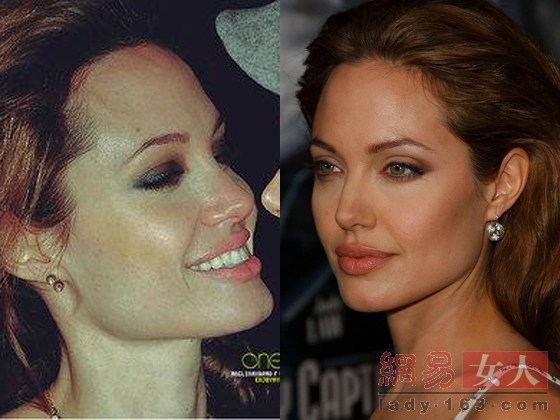  p>欧米伽下巴又被称作"美人沟","苹果下巴",英文一般叫做"cleft chin