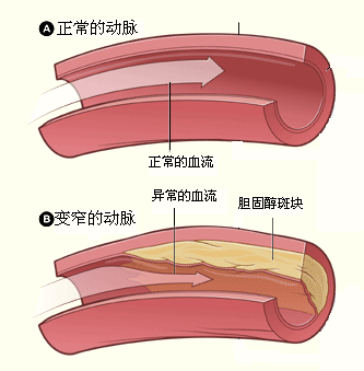p>所谓冠状动脉狭窄是粥样硬化所致,当狭窄到一定程度是导致心肌缺血