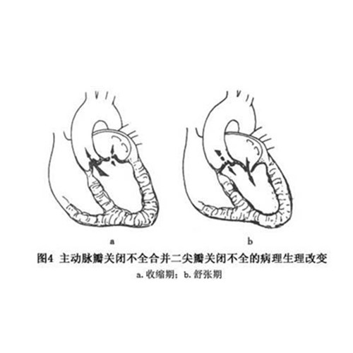 p>主动脉瓣关闭,不全病人的左室舒张期在接受左心房血液同时又额外地