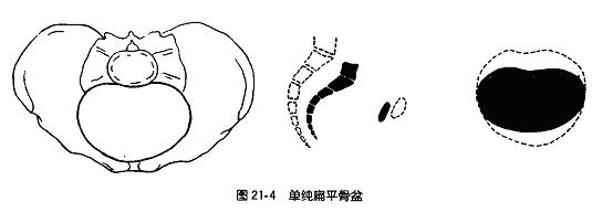 骨盆形态及组成骨间各径线异常可导致异常分娩.