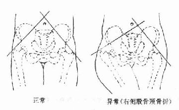  p>nelaton线是坐骨结节至髂前上棘的连线. /p>