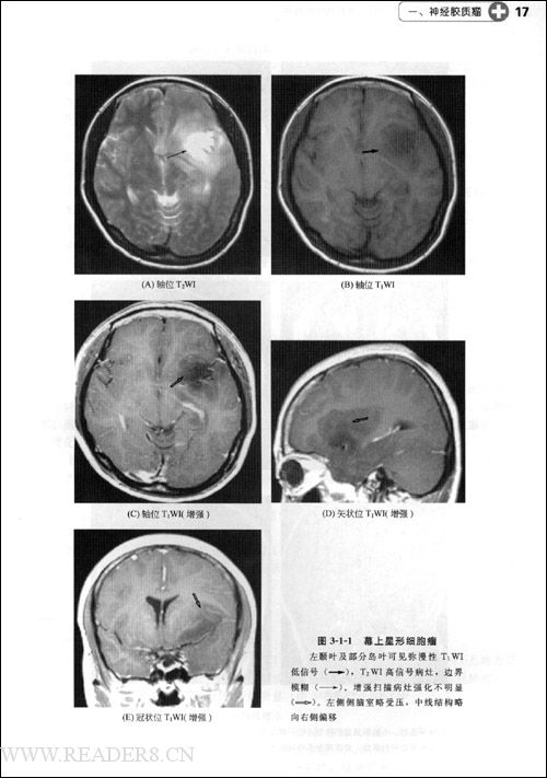 胰岛细胞类癌
