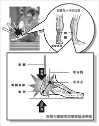 跟腱止点损伤