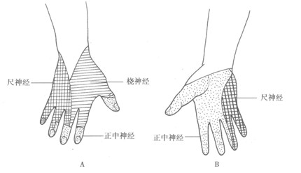 尺神经麻痹