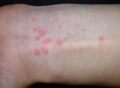  p>皮肤荨麻疹,俗称风团,是一种常见的皮肤病.