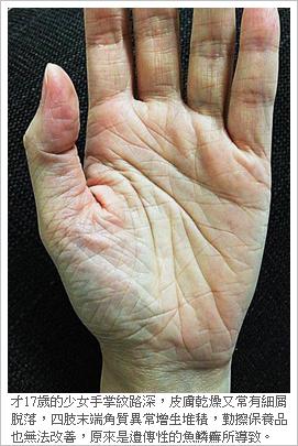 nigricans),x-连锁隐性遗传鱼鳞病(recessive x-linked ichthyosis)