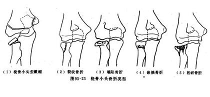 尺桡骨双骨折可发生重叠,成角旋转及侧方移位四种畸形.