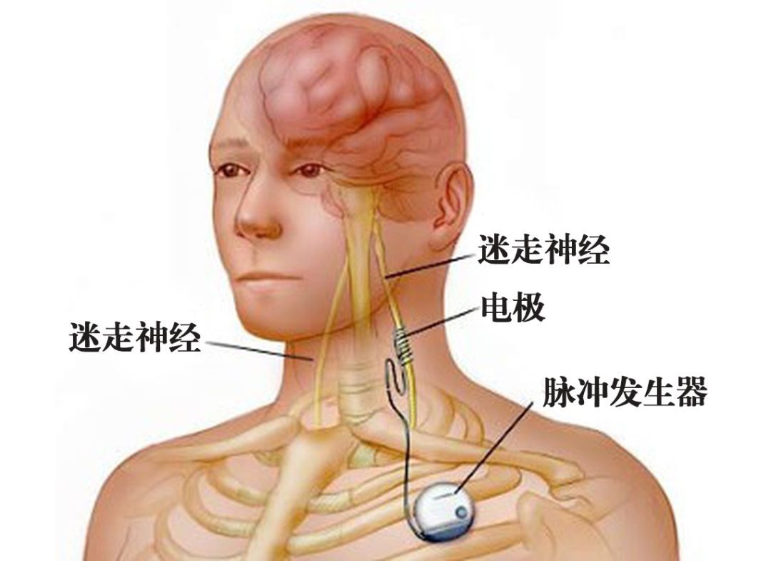 刺激迷走神经