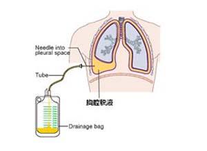 渗出性胸水