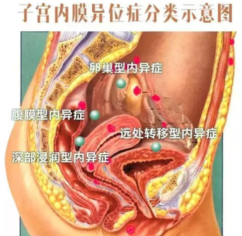 盆腔子宫内膜异位半保守性手术