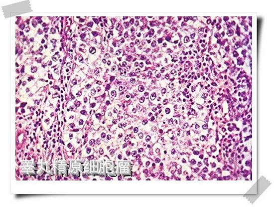 p></p></a>精原细胞瘤(seminoma)起源于 a target=