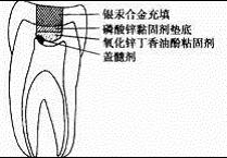 盖髓术