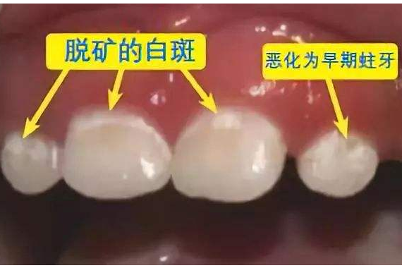 p《也叫脱钙,指人的牙齿牙釉质表面的钙磷脱落,因而使牙齿色泽改变
