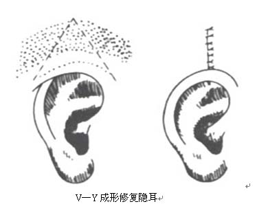  p></p></a>隐耳的手术原则为将耳郭软骨复位,做出颅耳沟.