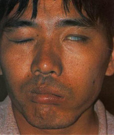 指 a target="_blank" href="/item/口眼歪斜/1026525" data-lemmaid=