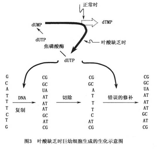 巨幼红细胞贫血