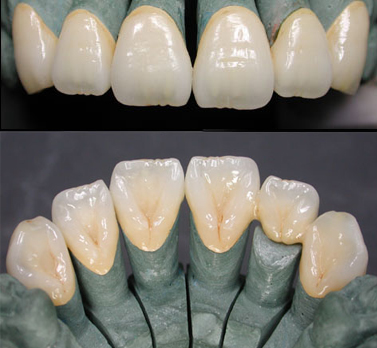 烤瓷牙钴铬合金