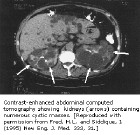 成人多囊肾脏疾病