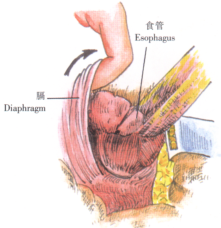 食管裂孔疝修补术