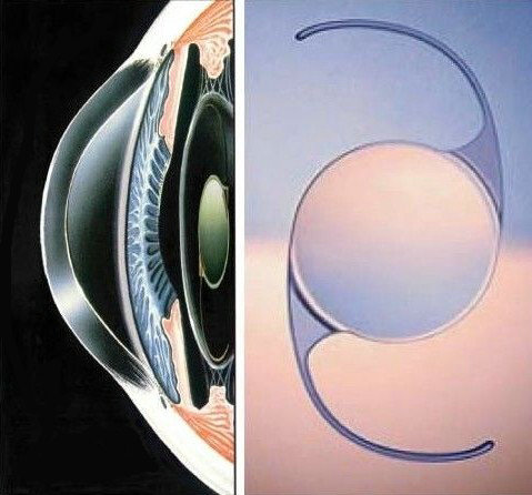 白内障超声乳化吸除人工晶体植入术