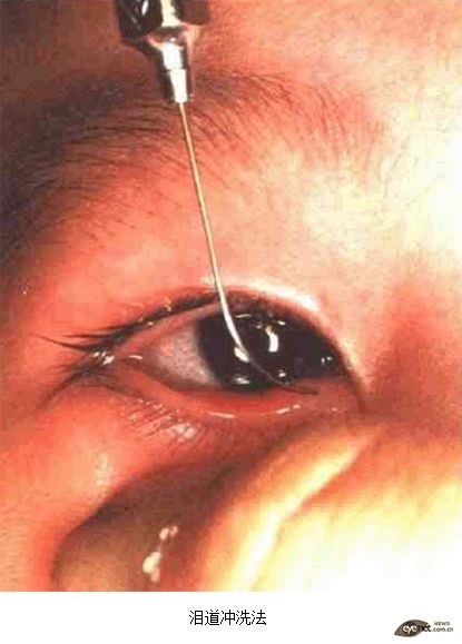  p>泪道冲洗术是通过将液体注入 a href="#" data-lemmaid="6265917">