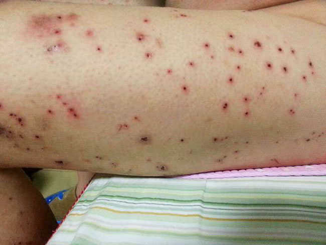  p>维生素c缺乏症也称为坏血病,所以维生素c称为 a target="_blank"