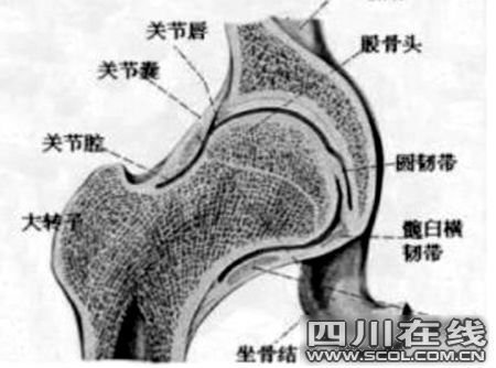 激素型股骨头坏死