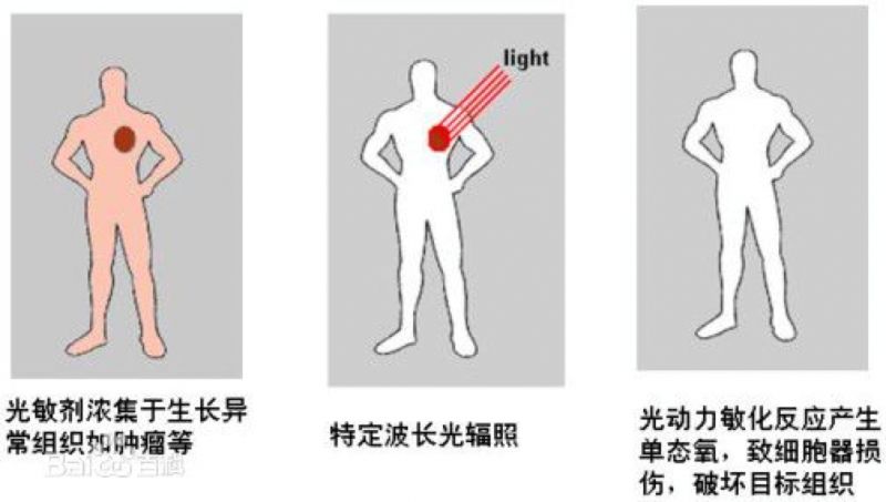 癌症的光动力疗法_百科TA说