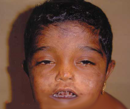 又称gunther病,先天性光敏性卟啉症和 a target="_blank" href="/item