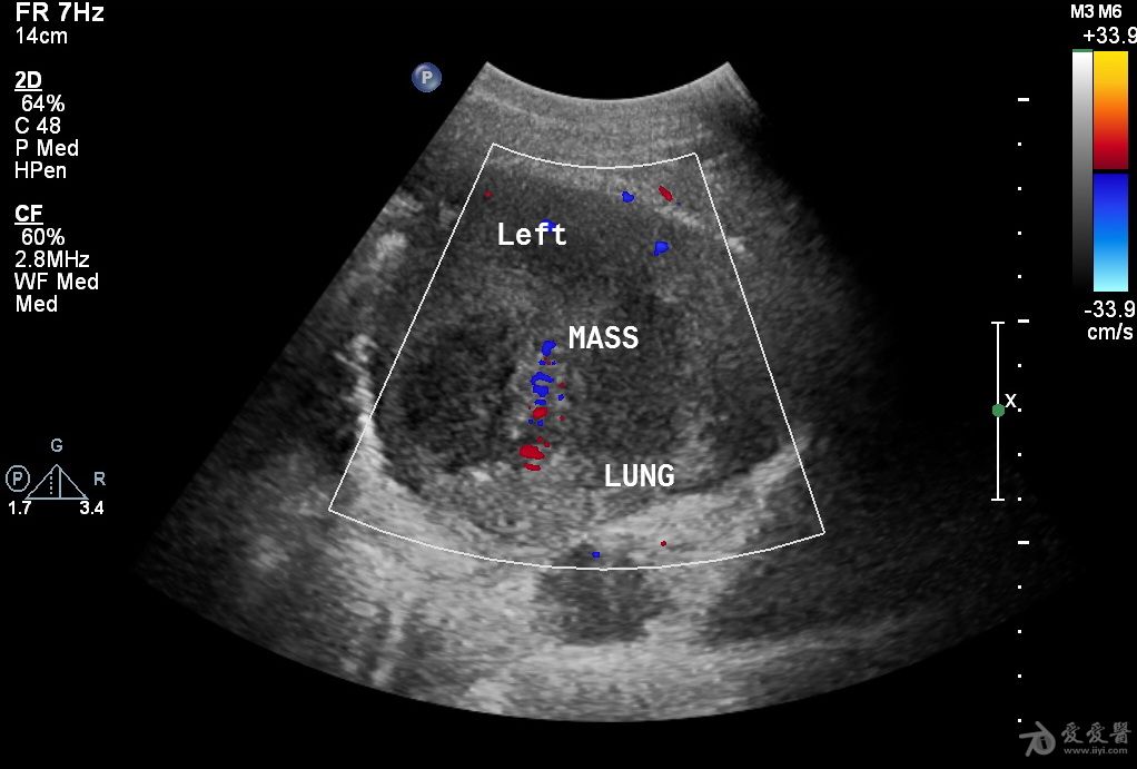 鳞状上皮细胞癌抗原存在于子宫,子宫颈,肺,头颈等鳞状上皮细胞癌的