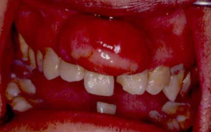  p>边缘龈,又称 a target="_blank" href="/item/游离龈/1049871"