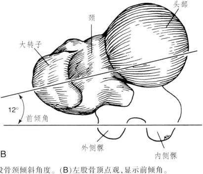 [股骨]前倾角