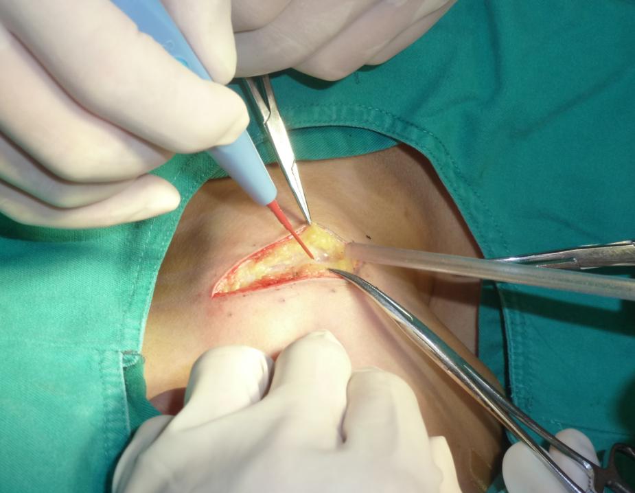 它很好的解决了高频电刀因手术功率大,频率高,电压高等因素所导致的