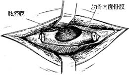 胸壁结核病灶清除术是用于治疗结核病的手术