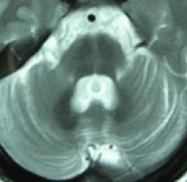  p>肌萎缩侧索硬化症,又称 a target="_blank" href="/item/渐冻人">