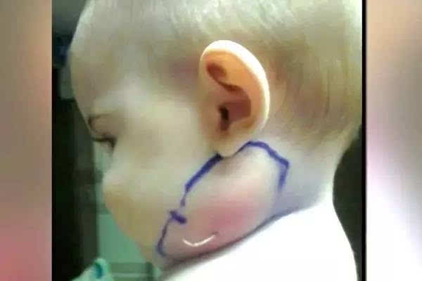 腮肿