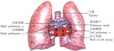单侧肺移植术