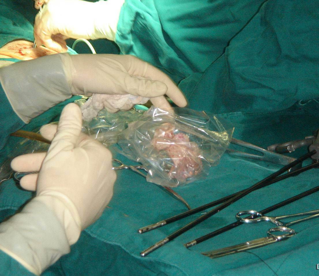  p>皮肤扩张术是通过在皮肤深面埋植扩张器并逐步扩张的方法,扩大其被