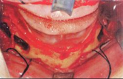  p data-id="2ihdsxouri6">下牙槽神经移位术示暴露下颌管的颊侧骨面