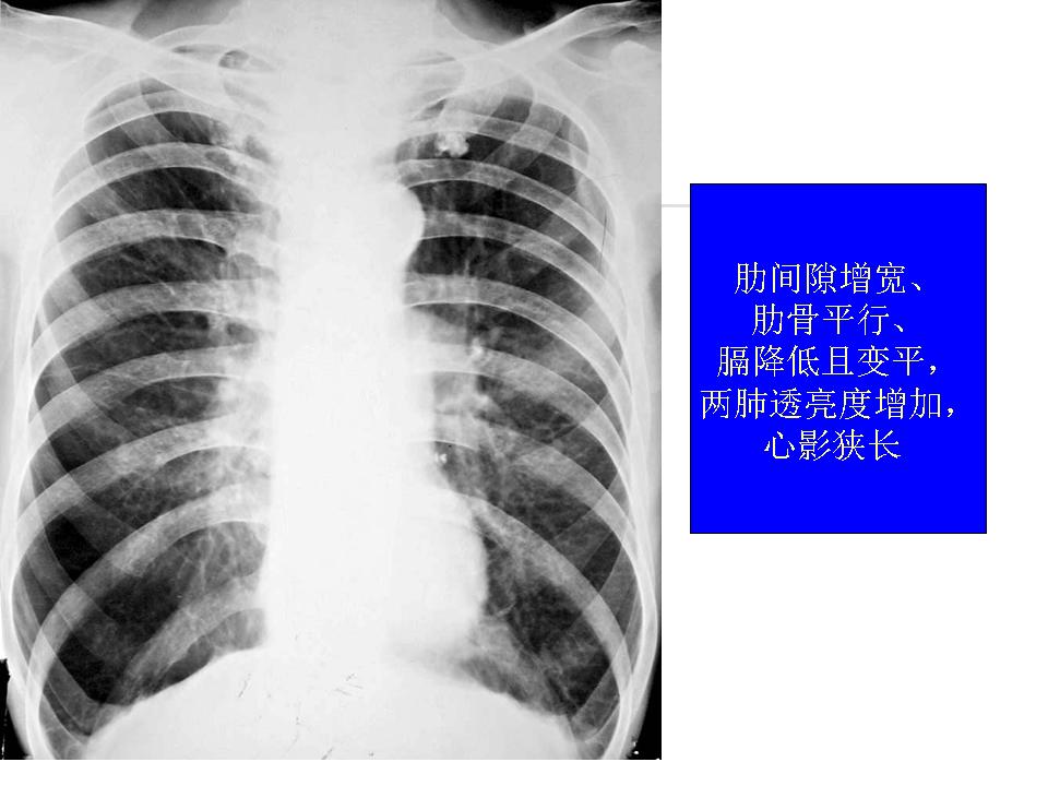  p data-id="gnbiynn6kc">慢性阻塞性肺疾病是一种重要的慢性呼吸系统