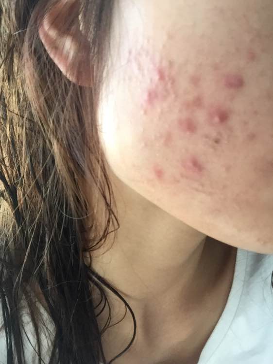 ">青春期 /a>脸上的 a target="_blank" href="/item/脓包/6930381"